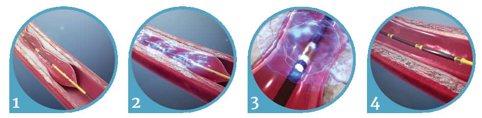 Shockwave IVL | Best Heart Specialist in Indore