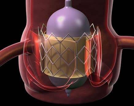 Transcatheter Aortic Valve Implantation | TAVI | What is TAVI & how it is done ? | Best cardiac surgeon in Indore