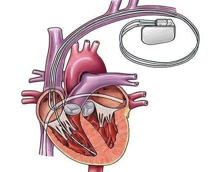 Combo Device Implantation | Heart Disease Dr in Indore | Best Heart Specialist dr in Indore