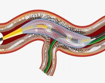 Shock wave Lithotripsy | IVL | Best cardiac surgeon in Indore