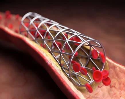 Stent Implantation | Best Stent Implantation in Indore | Best Heart Specialist in Indore